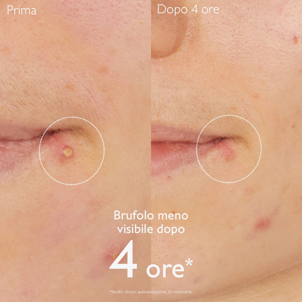 Vinopure Soluzione Salicilica Stop Brufoli 15 Ml