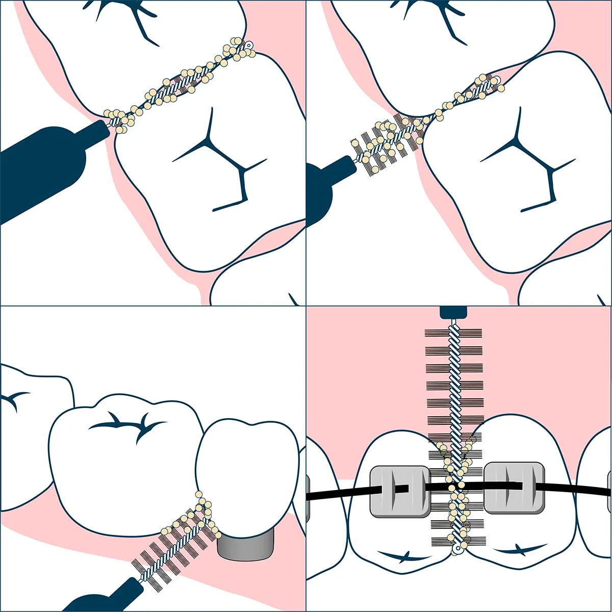 Geldis Doctor Pick Scovolino XS 7 Pezzi Cura denti e cavo orale