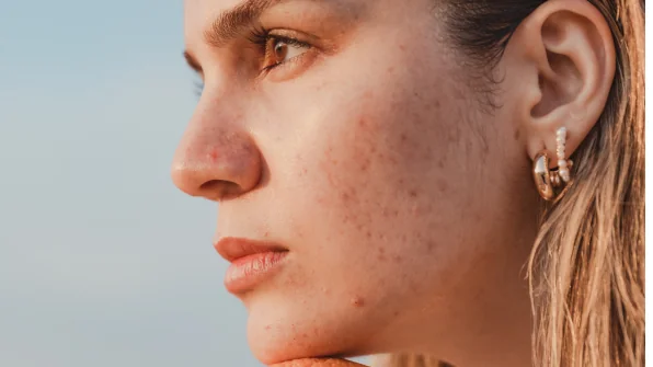 Skincare per pelle acneica: guida pratica alla routine quotidiana efficace