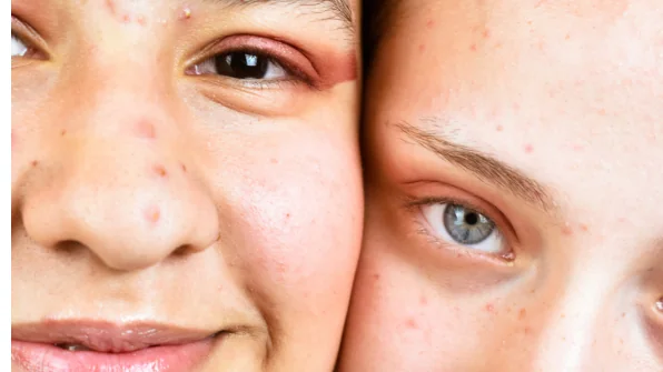 Isotretinoina e Acne: cosa sapere prima di iniziare il trattamento