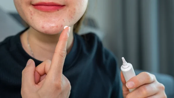 Macchie Cutanee: Come toglierle con creme e consigli utili