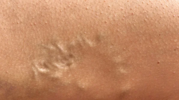 Creme per le vene varicose e capillari gambe: Guida alle pomate
